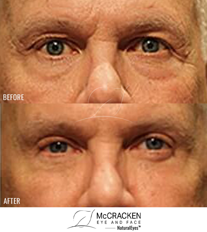 62 Year Old Male – Upper and Lower Blepharoplasty