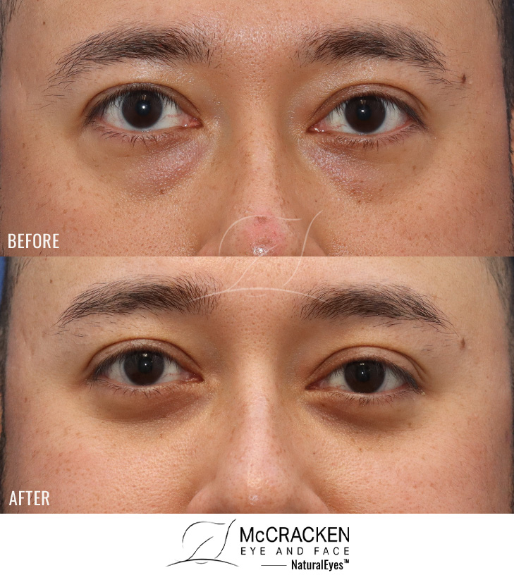 33 Year Old Male – Lower Blepharoplasty. No skin incisions were made.