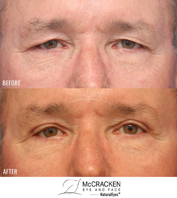 66 Year Old Male – Upper Blepharoplasty