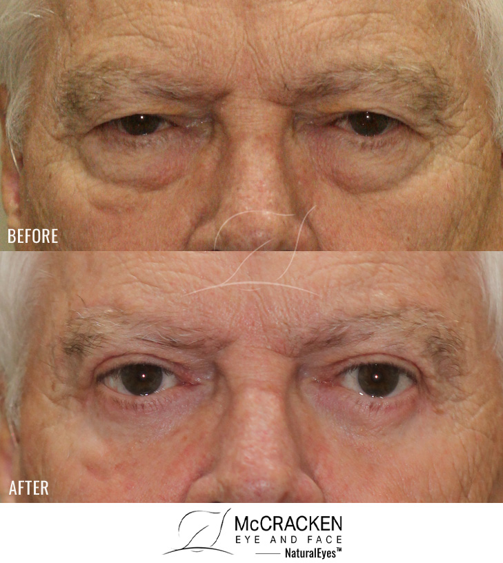 76 Year Old Gentleman – Direct Brow Lift, Upper Blepharoplasty, and Lower Blepharoplasty with Cheek Lift