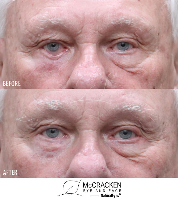 78 Year Old Male – Repair of Right Lower Lid Retraction After Unsatisfactory Skin Cancer Repair elsewhere