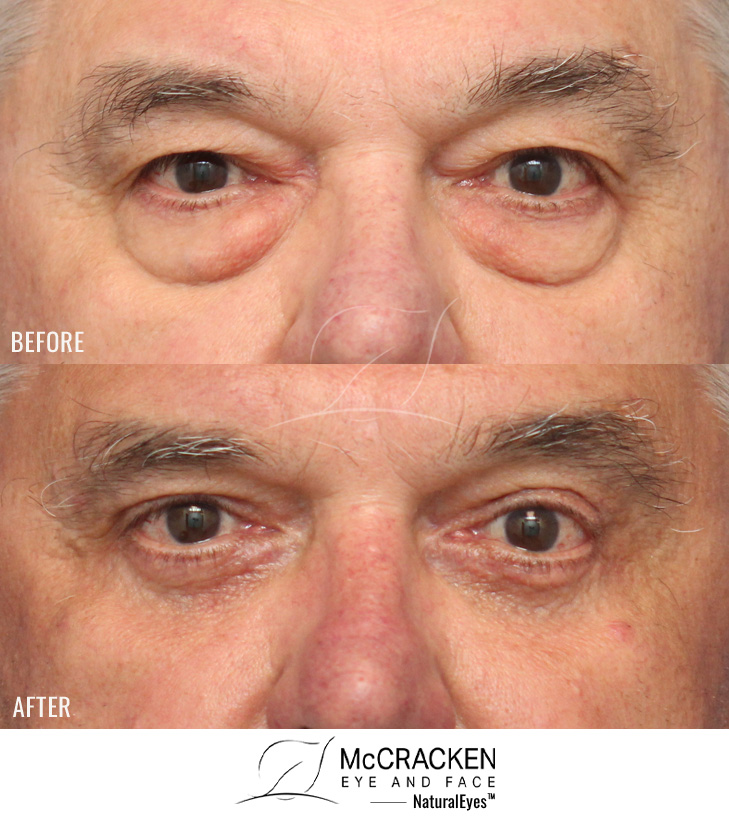 66 Year Old Male – Upper and Lower Blepharoplasty with Skin Muscle Flap Excision.