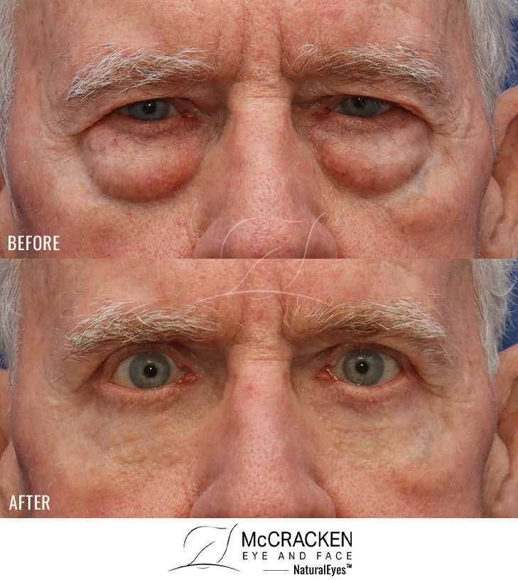 72 Year Old Male – Upper and Lower Blepharoplasty with Lower Lid Skin Pinch Excision.