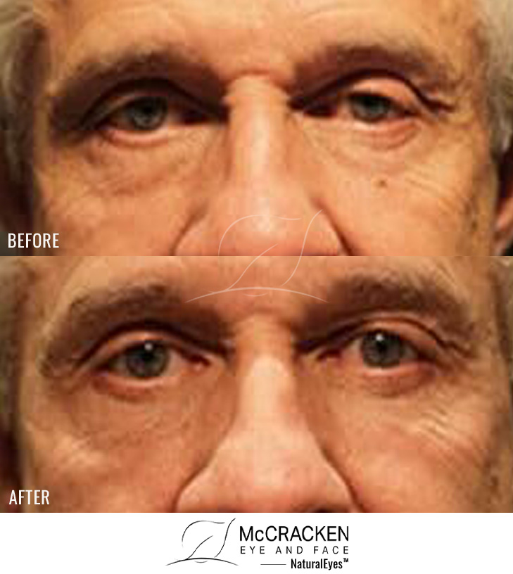 62 Year Old – Upper Lid Ptosis Repair and Bilateral Lower Blepharoplasty