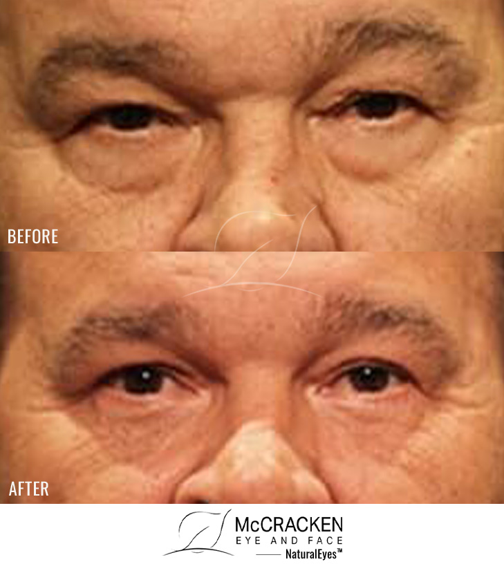 56 Year Old – Male Upper and Lower Blepharoplasty