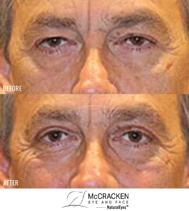 56 Year Old Male – Upper Blepharoplasty
