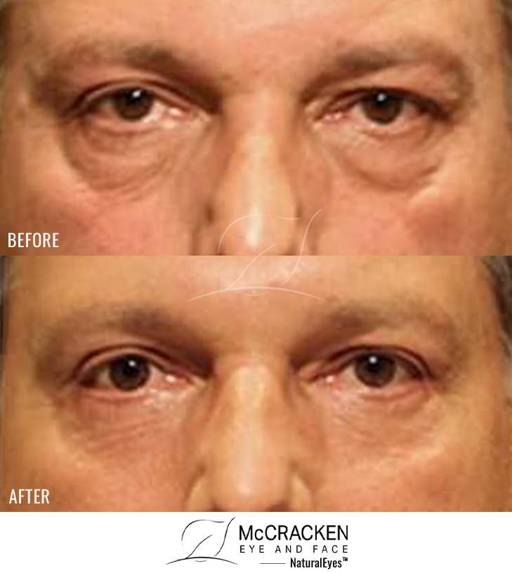 53 Year Old Male – Upper and Lower Blepharoplasty