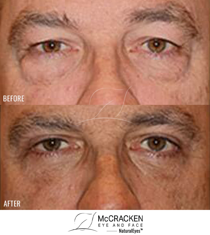 59 Year Old – Male Upper and Lower Blepharoplasty