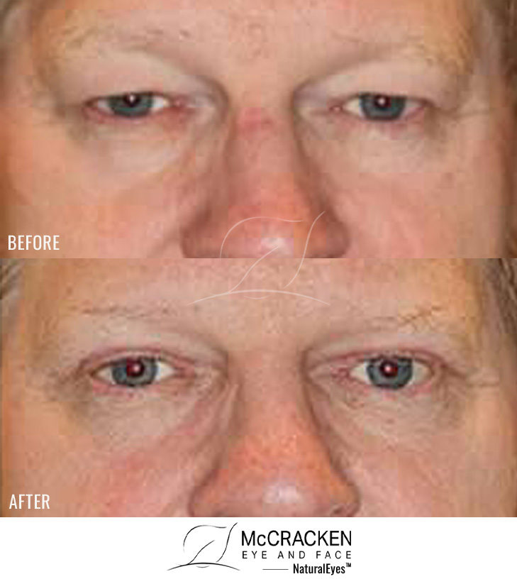 54 Year Old Male – Upper Blepharoplasty with Brow Pexy