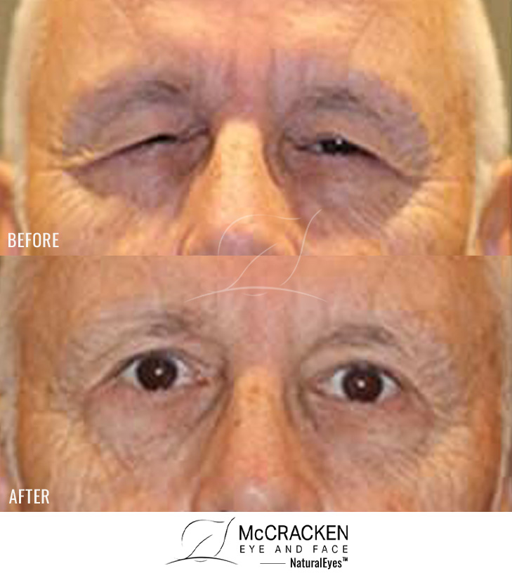 69 Year Old Male – Upper Blepharoplasty with Brow Pexy