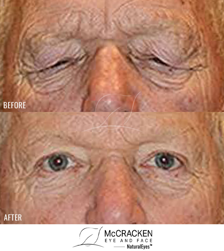 70 Year Old Male – Upper Blepharoplasty and Brow Lift