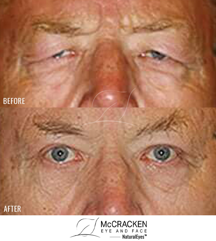 Male – Upper Blepharoplasty