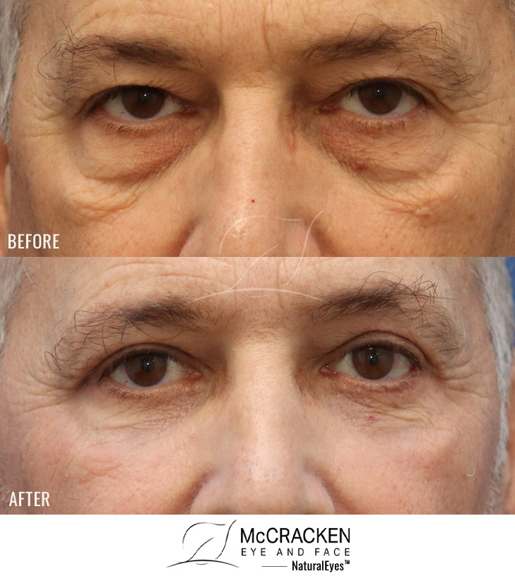 61 Year Old Male – Upper Lid Blepharoplasty with Brow Pexies, Lower Lid Blepharoplasty with Laser Skin Resurfacing. A Skin Pinch Excision Was Used to Remove a Small Amount of Excess Skin.