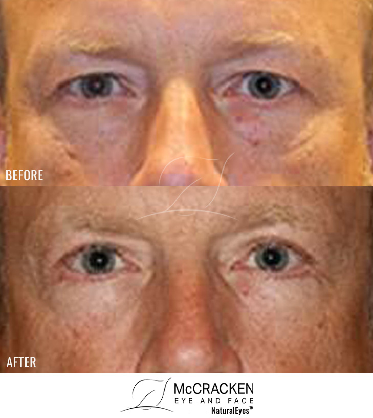 57 year old male – upper and lower Blepharoplasty