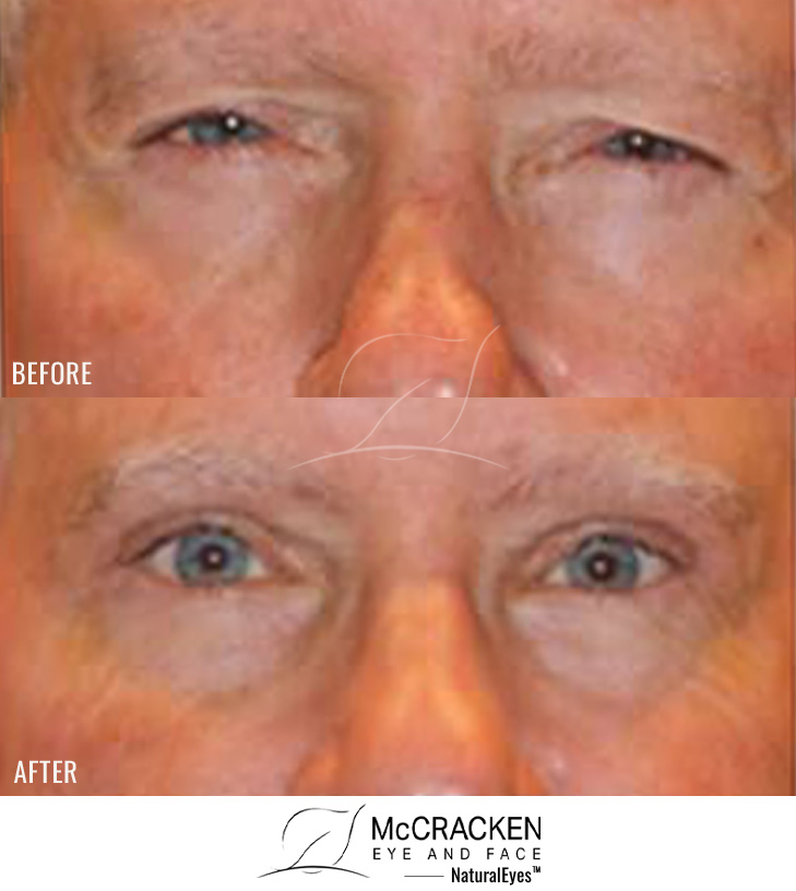 67 Year Old Male – Upper Blepharoplasty