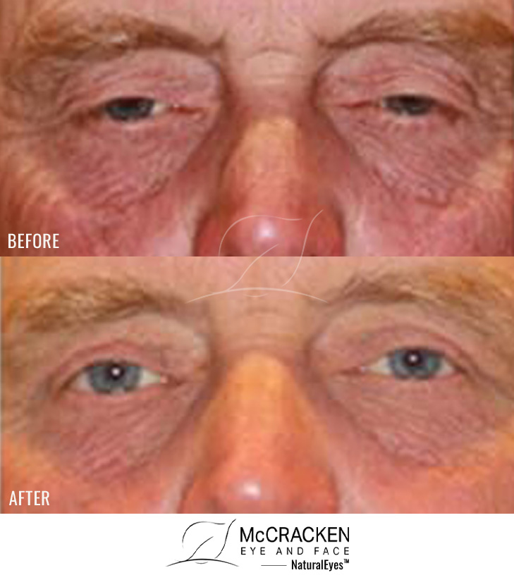 61 Year Old Male – Upper Blepharoplasty