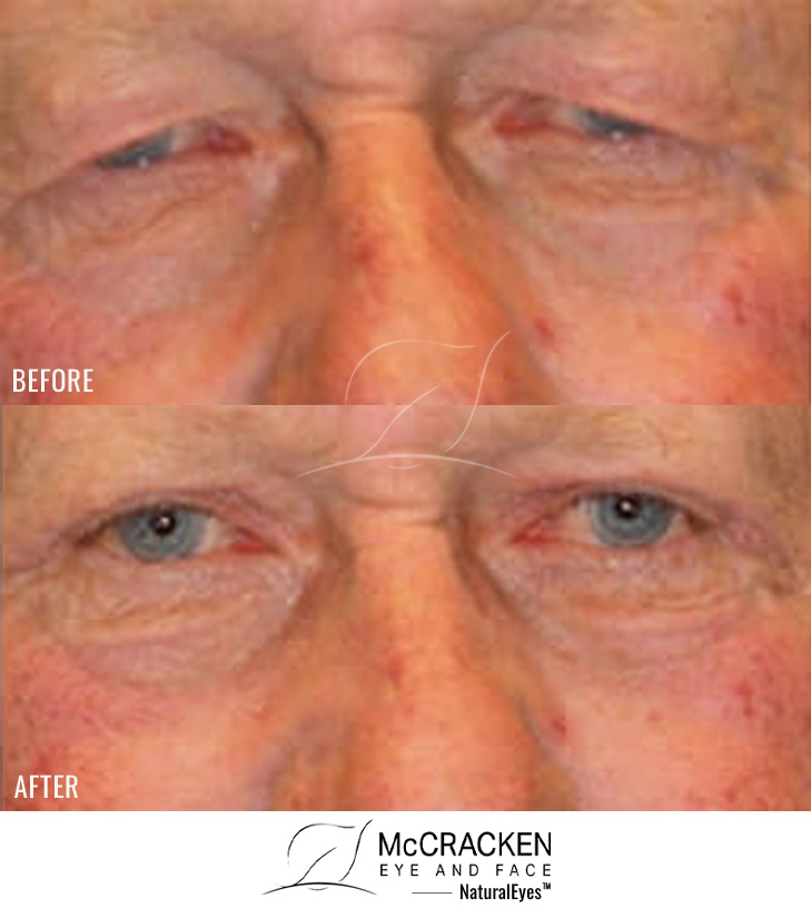 72 Year Old Male – Upper Blepharoplasty