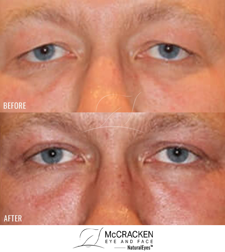 43 Year Old Male – Upper Blepharoplasty