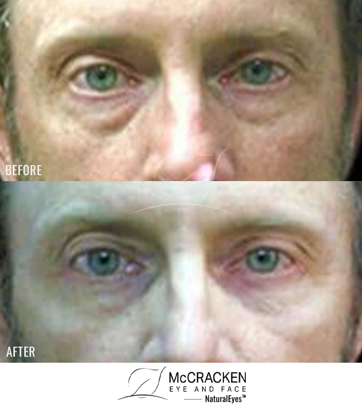 54 Year Old Male – Lower Blepharoplasty