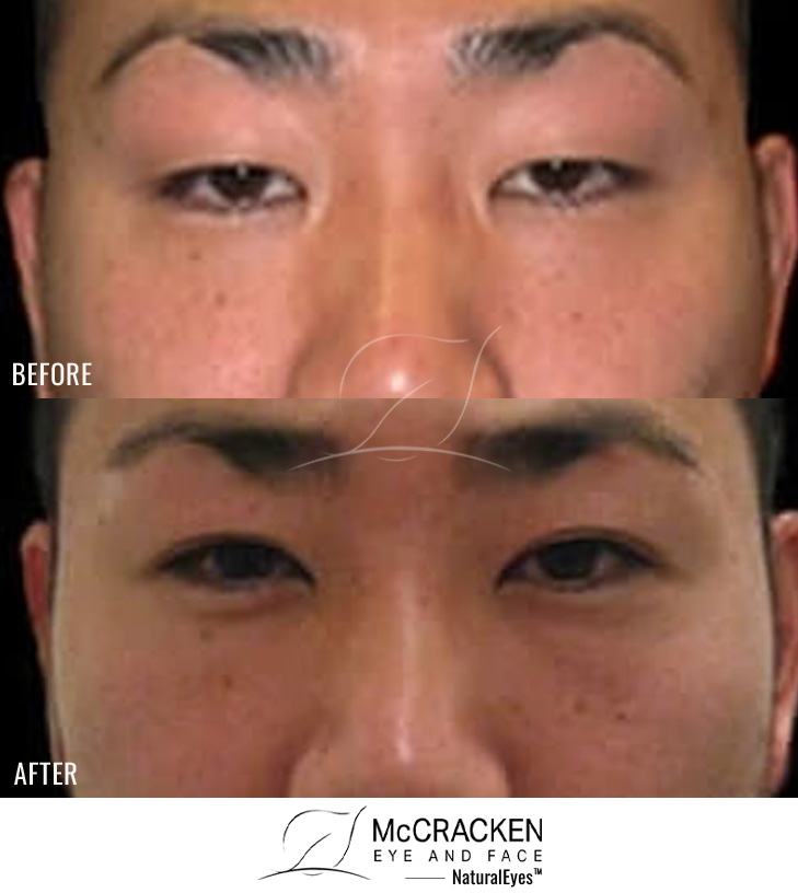 32 Year Old Male – Upper Blepharoplasty