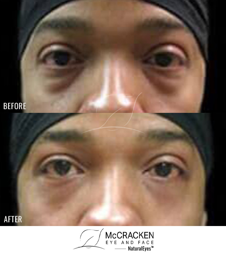 Lower Blepharoplasty