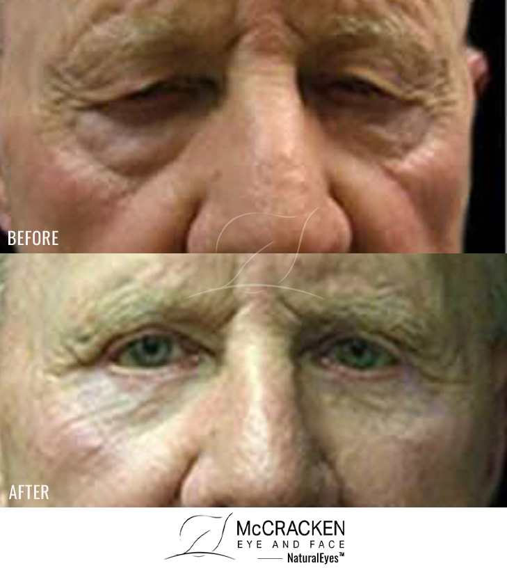 72 Year Old Male – Upper and Lower Blepharoplasty with Mid-Facelift