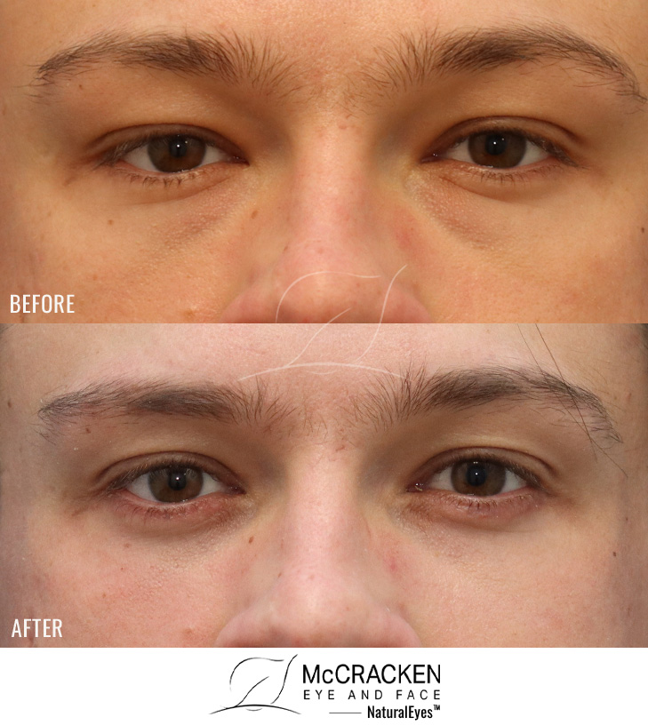 29 Year Old Male – Lower Blepharoplasty with Laser Skin Resurfacing. A Skin Pinch Excision Was Used to Remove a Small Amount of Excess Skin.