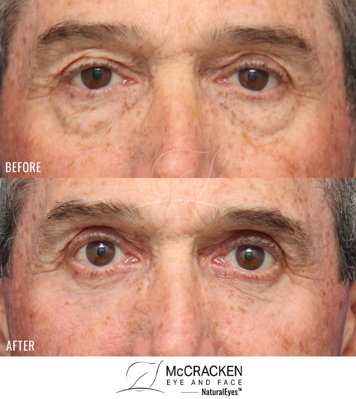 59 Year Old Male – Upper and Lower Blepharoplasty with Laser Skin Resurfacing. No lower lid skin incisions were made.