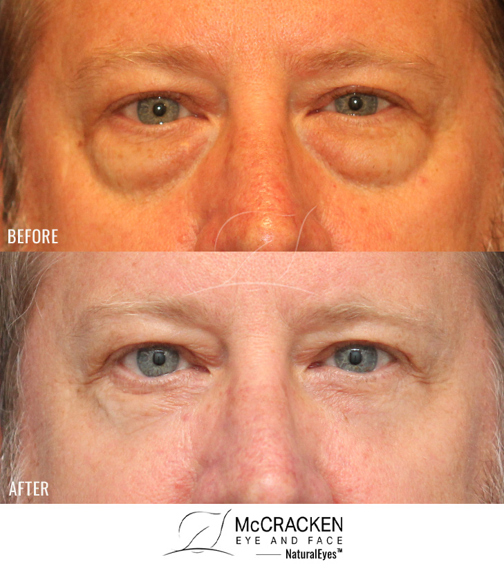 52 Year Old Male – Lower Blepharoplasty with Laser Skin Resurfacing. No lower lid skin incisions.