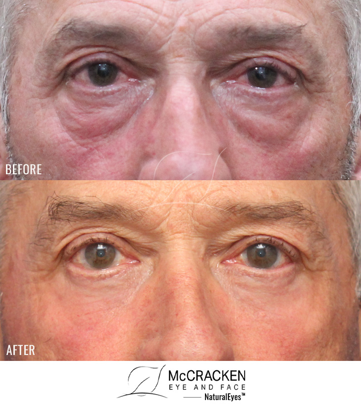 67 Year Old Male – Lower Blepharoplasty with Laser Skin Resurfacing. No skin incisions.