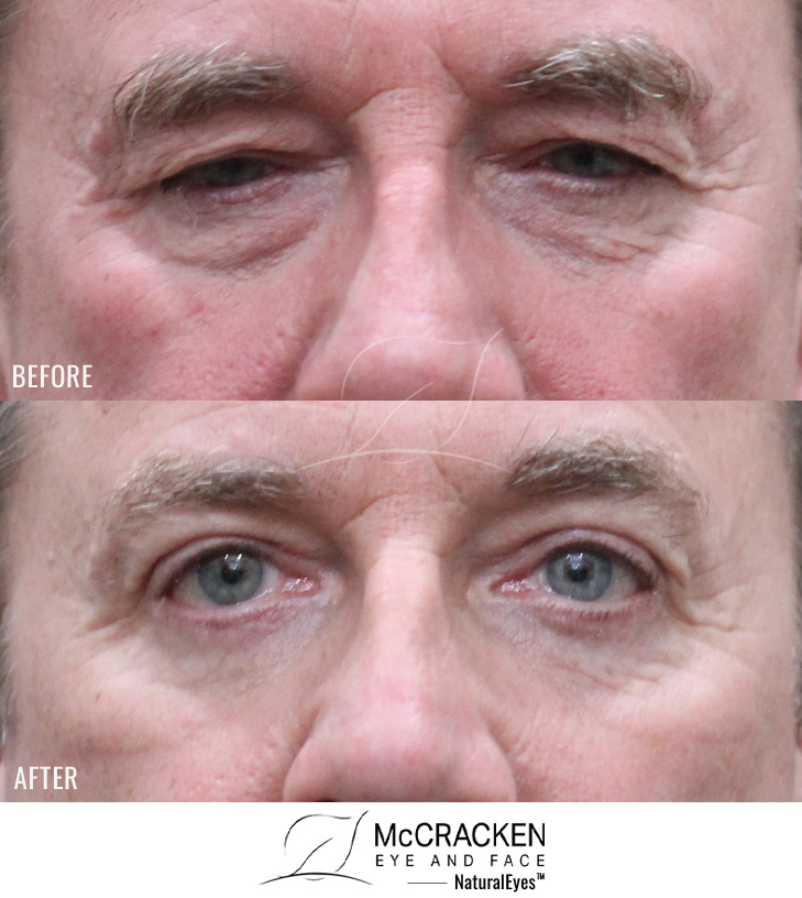 59 Year Old Male – Upper and Lower Blepharoplasty
