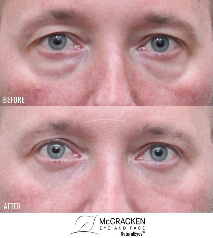 46 Year Old Male – Upper and Lower Blepharoplasty. No Lower Lid Skin Incisions