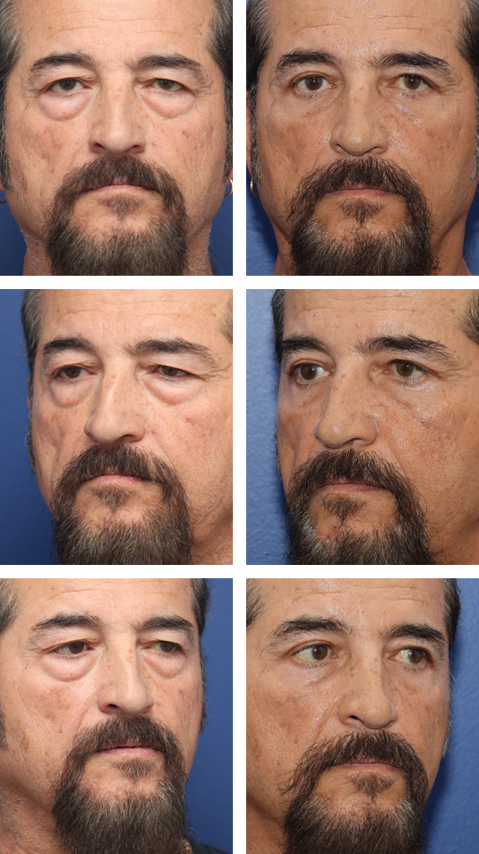  Before and After Picture 
68 Year Old Male – Upper and Lower Blepharoplasty with Internal Brow Lift. No lower lid skin incisions were made.
