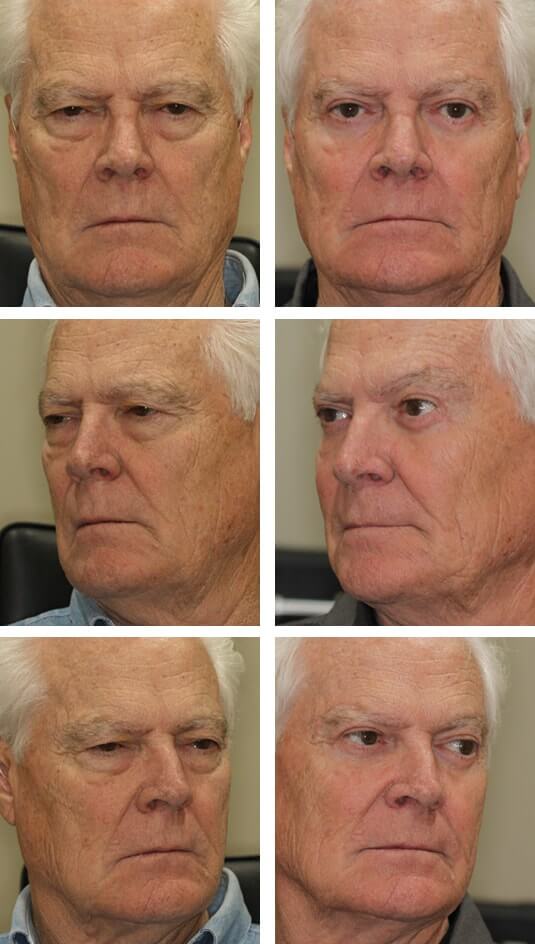  Before and After Picture  
76 Year Old Gentleman – Direct Brow Lift, Upper Blepharoplasty, and Lower Blepharoplasty with Cheek Lift