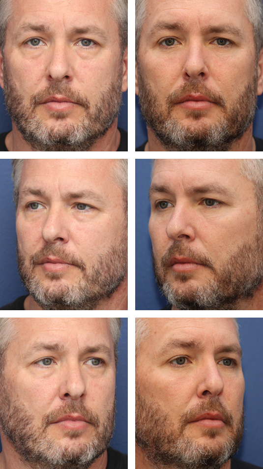  Before and After Picture  
54 Year Old Male – Lower Blepharoplasty with AccuTite Radiofrequency skin tightening. No lower lid skin incisions were made.