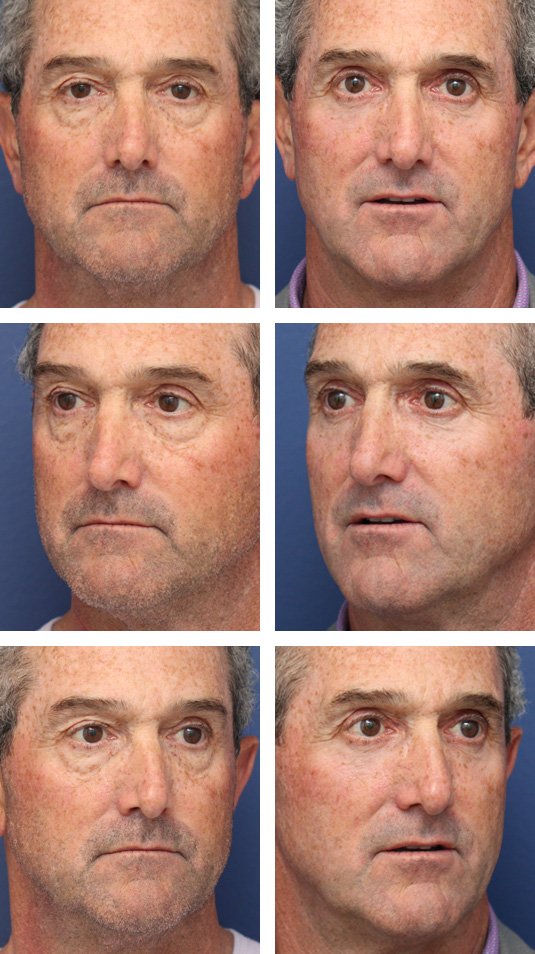  Before and After Picture 
59 Year Old Male – Upper and Lower Blepharoplasty with Laser Skin Resurfacing. No lower lid skin incisions were made.
