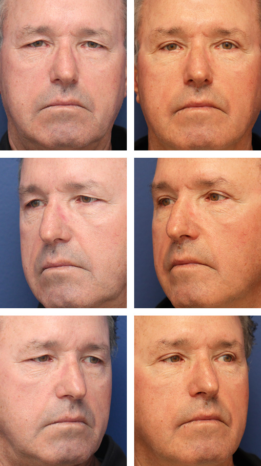  Before and After Picture 
66 Year Old Male – Upper Blepharoplasty