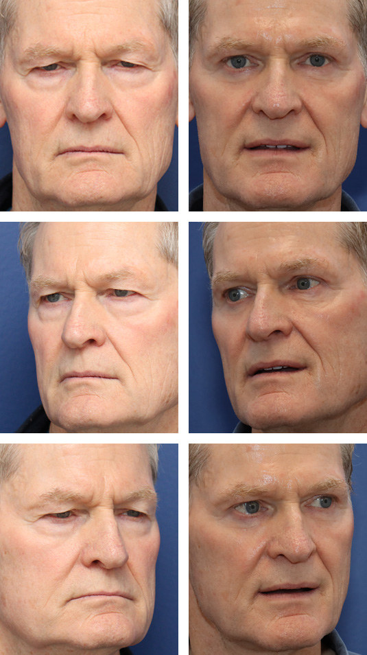  Before and After Picture 
71 Year Old Male – Upper and Lower Blepharoplasty with Laser Skin Resurfacing. No lower lid skin incisions were made.