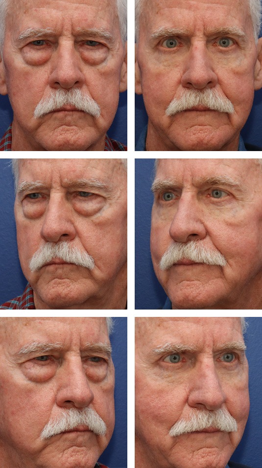  Before and After Picture 
72 Year Old Male – Upper and Lower Blepharoplasty with Lower Lid Skin Pinch Excision.
