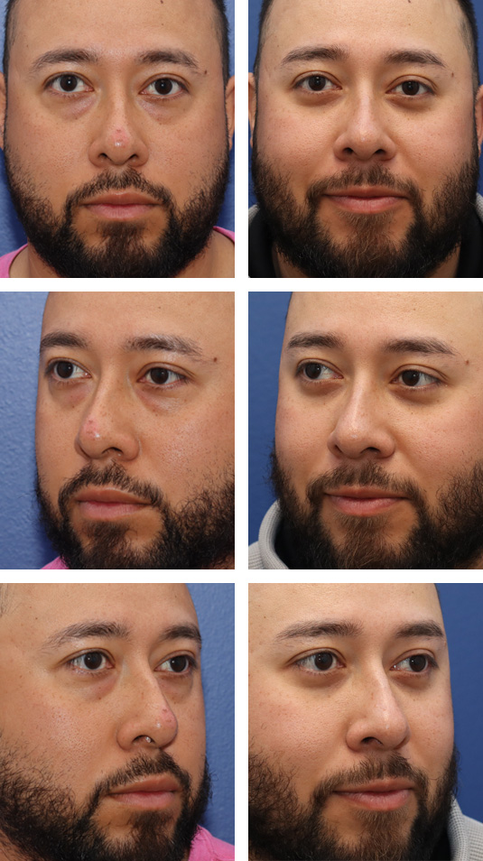  Before and After Picture 
33 Year Old Male – Lower Blepharoplasty. No skin incisions were made.