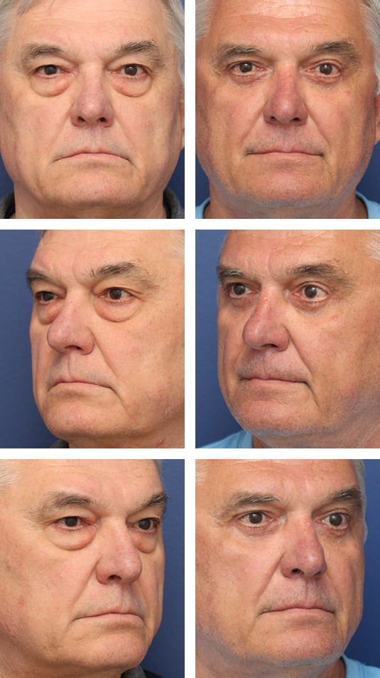  Before and After Picture 
66 Year Old Male – Upper and Lower Blepharoplasty with Skin Muscle Flap Excision.