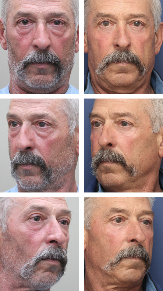  Before and After Picture  
67 Year Old Male – Lower Blepharoplasty with Laser Skin Resurfacing. No skin incisions.