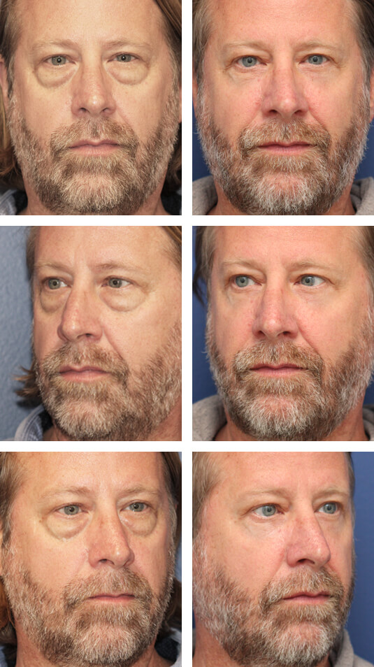  Before and After Picture  
52 Year Old Male – Lower Blepharoplasty with Laser Skin Resurfacing. No lower lid skin incisions.