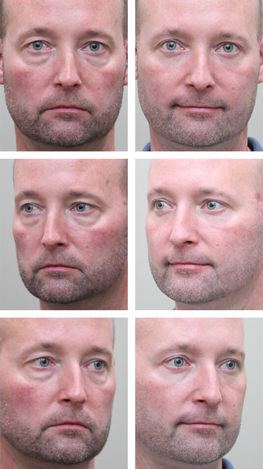  Before and After Picture  
46 Year Old Male – Upper and Lower Blepharoplasty.  No Lower Lid Skin Incisions
