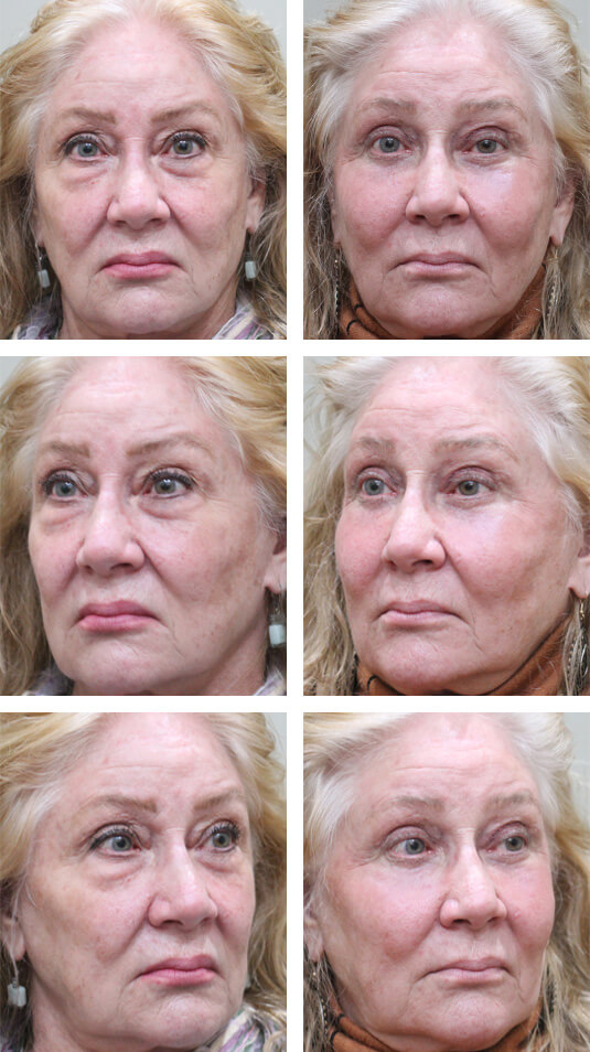 Before and After Picture 
67 Year Old Female - Bilateral Upper and Lower Blepharoplasty with Endoscopic Midface Lift and Periocular Laser Skin Resurfacing.