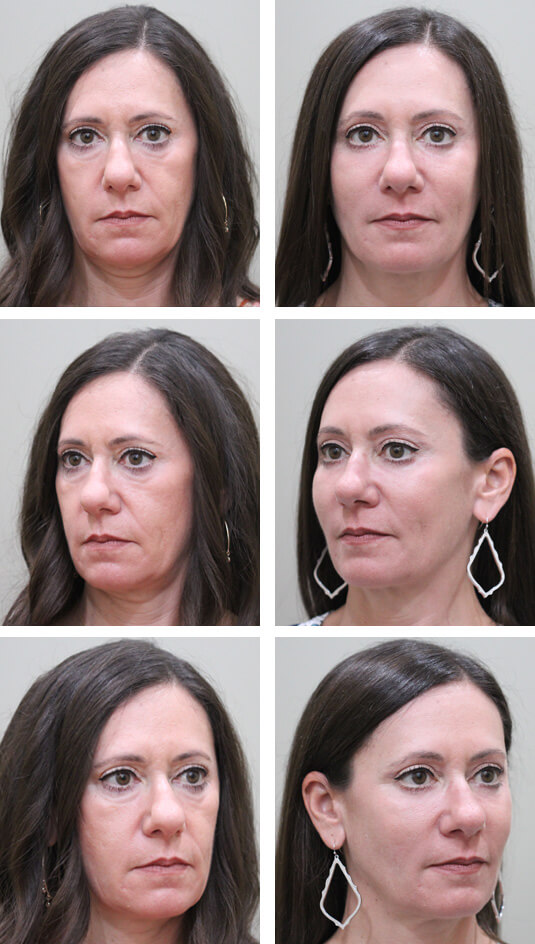 Before and After Picture 
51 Year Old Female - Mid-Facelift with lower blepharoplasty, Periocular Laser Skin Resufacing, and Temporal Brow Lift.  The Mid-Facelift was performed through incisions in the mouth and temples, without any skin incisions.