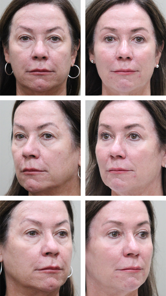  Before and After Picture 
60 Year Old Female – Mid-Facelift with upper and lower blepharoplasty, and Periocular Laser Skin Resufacing. The Mid-Facelift was performed through incisions in the mouth and temples, without any skin incisions.