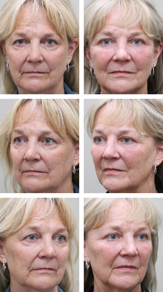  Before and After Picture 
68 Year Old Female – Mid-Facelift with Lower Blepharoplasty, Periocular Laser Skin Resurfacing, and Temporal Brow Lift. The Mid-Facelift was performed through incisions in the mouth and temples, without any skin incisions.