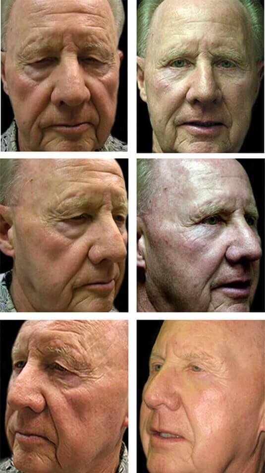  Before and After Picture 
72 Year Old Male - Upper and Lower Blepharoplasty with Mid-Facelift