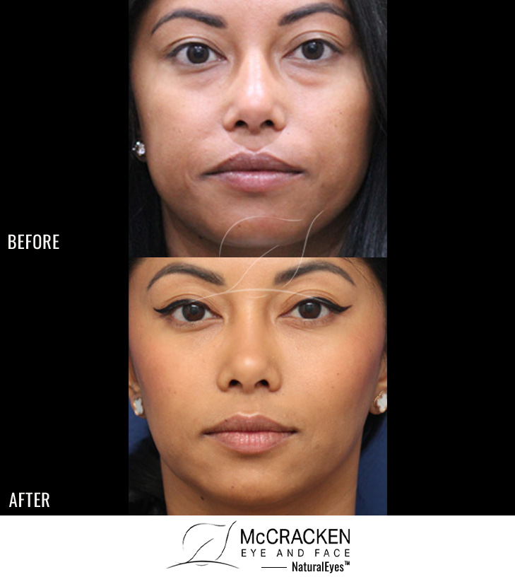 35 Year Old Female –Neurotoxin to Masseter Muscles to Slim Jawline